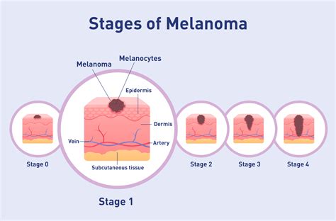 stage 1 pink melanoma pictures